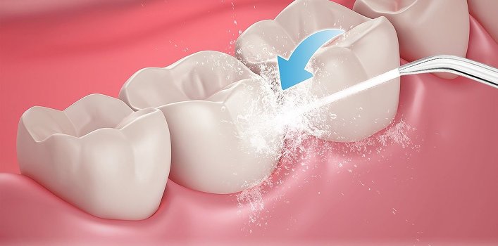 Pourquoi ai-je besoin d'un irrigateur oral?